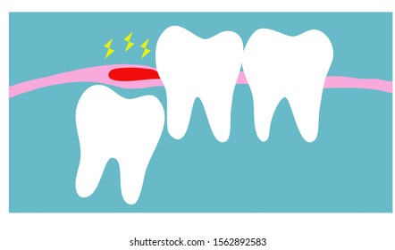 Wisdom tooth or impacted tooth