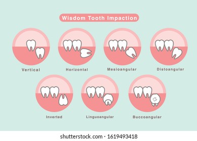 Wisdom Tooth Impaction Icon Set