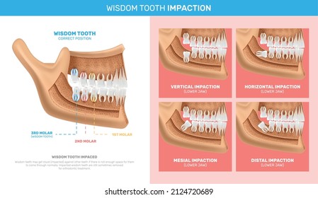 Wisdom tooth impaction infographics with anatomy chart and different options of problem realistic vector illustration