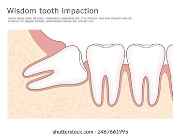 Wisdom tooth impaction inside view dental vector illustration.