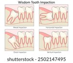 wisdom tooth impaction. mesial, horizontal, distal, and vertical, highlighting different dental conditions diagram hand drawn schematic vector illustration. Medical science educational illustration