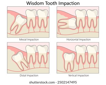 wisdom tooth impaction. mesial, horizontal, distal, and vertical, highlighting different dental conditions diagram hand drawn schematic vector illustration. Medical science educational illustration