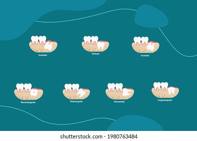 Wisdom tooth impaction set vector  illustration.