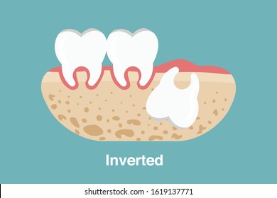 Wisdom tooth ( Inverted impaction ) illustration Vector.