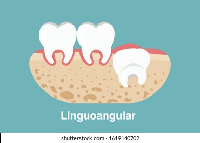 Wisdom tooth ( Linguoangular impaction ) illustration Vector.