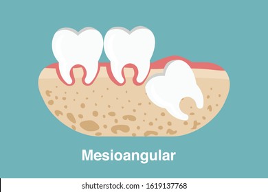 Wisdom tooth ( Mesioangular impaction ) illustration Vector.