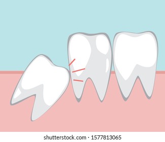 Wisdom tooth, oral problem. Flat vector stock illustration. The wisdom tooth in the mouth does not grow properly. Molar growth concept, dental problem. Illustration with molars on the gum