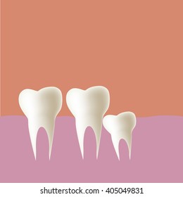 Wisdom tooth (Partial Eruption) in mouth, Vector illustration.