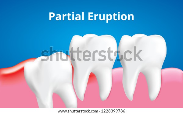 炎症の影響を受けた親知らず 部分的な噴火 歯科ケアのコンセプト リアルなイラストベクター画像 のベクター画像素材 ロイヤリティフリー