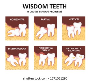 Wisdom tooth. Possible problems because of the third molar