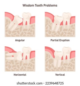 Problemas dentales de sabiduría. Impacción, dientes de sabiduría creciendo con ángulo equivocado. Ilustración vectorial plana