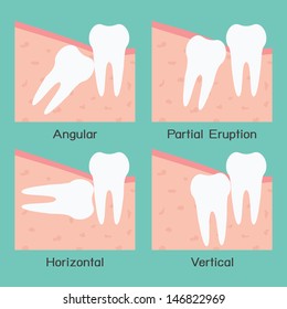 Wisdom Tooth, Vector