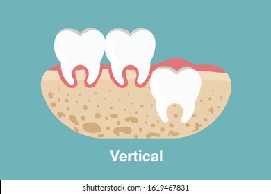 Wisdom tooth ( Vertical impaction ) illustration Vector.