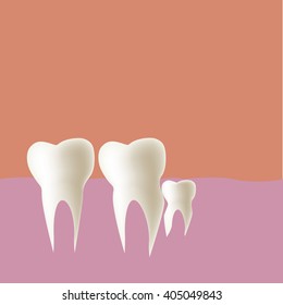 Wisdom tooth (Vertical) in mouth, Vector illustration.