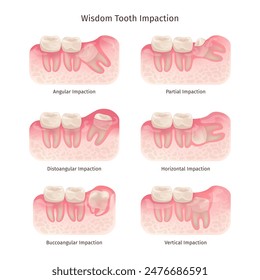 Wisdom tooth. Wisdoms teeth dental problem, molar extraction root canal bone or gum pain surgery treatment remove teeths dentist x ray infographic, swanky vector illustration