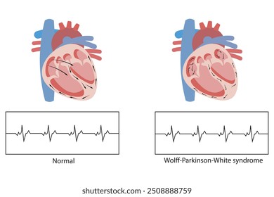 
Síndrome de Wolff-Parkinson-White, afección cardíaca que causa latidos cardíacos rápidos debido a una vía eléctrica adicional, fibrilación auricular, taquicardia supraventricular y paro cardíaco repentino.