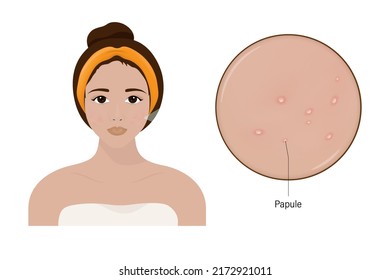 Woman with acne and a close up enlarged image of the facial skin showing papules.
Acne problem. Vector for cosmetic and beauty advertising.