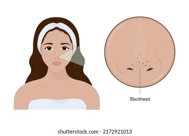 Woman with acne and a close up enlarged image of the facial skin showing blackheads.
Acne problem. Comedones. Vector for cosmetic and beauty advertising.