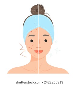 С artoon mujer con problema acné comparado con mujer con piel normal. Persona del concepto de procedimiento de cuidado de la piel. Ilustraciones de diseño de vectores.