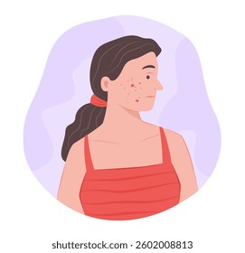 Woman with Acne and Scar on Face for Dermatological Symptom Concept Illustration Clip Art