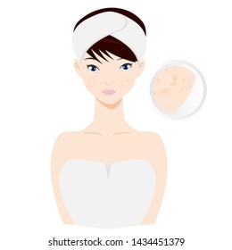 woman with acne scar skin problem. skincare and diseases concept.Vector illustration isolated on white background.