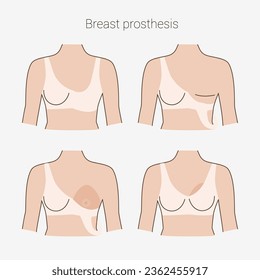 Woman after mastectomy. A girl without breasts tries on a breast prosthesis. Breast cancer. Vector illustration.