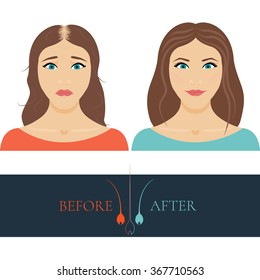 Woman with alopecia before and after hair treatment and transplantation. Female baldness set. Health and beauty concept design. Isolated vector illustration.
