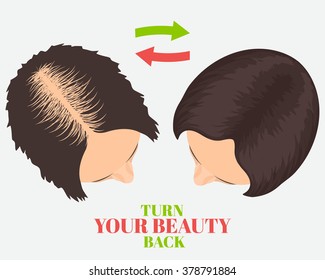 Woman with alopecia before and after hair treatment and transplantation. Turn Your Beauty Back quote. Female baldness set. Health concept design. Isolated vector illustration.