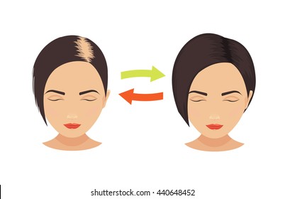 Woman with alopecia problem before and after hair treatment and transplantation. Female pattern baldness set. Beauty concept. Isolated vector illustration.