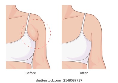 Ilustración vectorial de pérdida de grasa de axila. Antes y después.