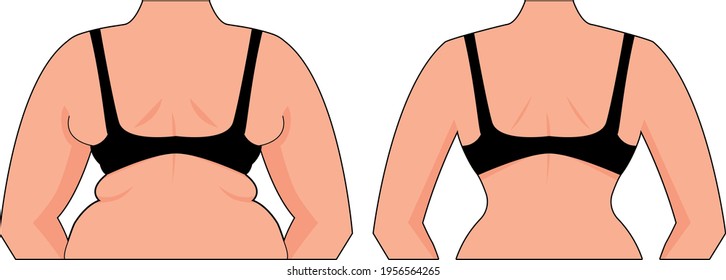 Woman back fat before and after vector illustration