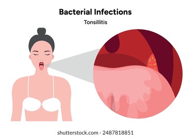Woman and Bacterial infections tonsillitis, open mouth with zoom