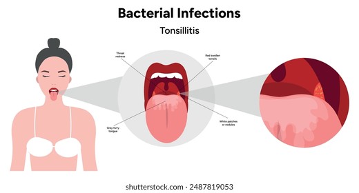 Woman with Bacterial infections tonsillitis, open mouth with zoom effect tonsils 