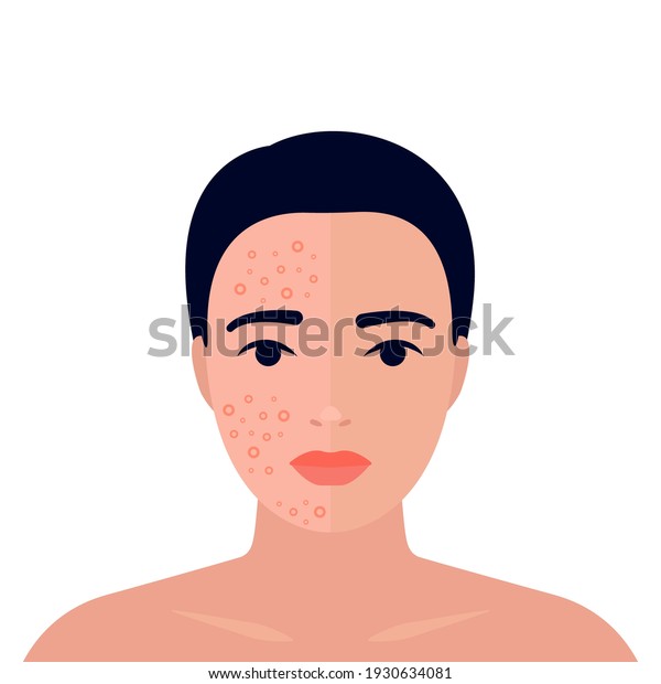 Woman Before After Acne On Skin Stock Vector (Royalty Free) 1930634081 ...