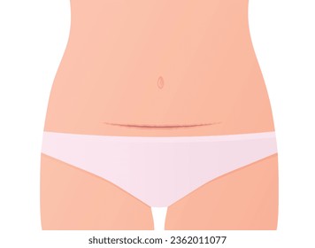 woman belly with a scar from a cesarean section - vector illustration
