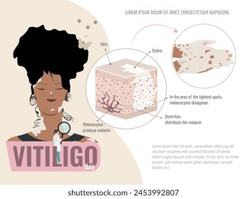 A woman with black hair and a green shirt is shown with an illustration of a skin condition called vitiligo. Graphic scheme of the skin with this disease.Vitiligo disease education concept