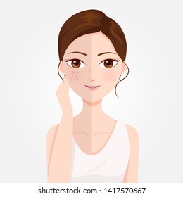 Woman with blemish Dark spots on the face And the brightness of the face