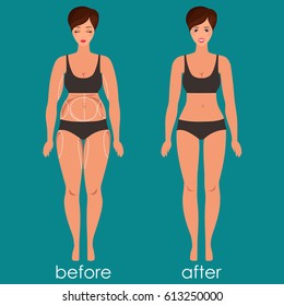 Woman body before and after plastic surgery. Body correction medicine concept. Vector illustration in modern flat design.