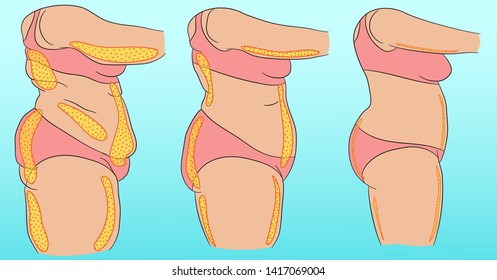 Woman body with designation of cellulite or fat