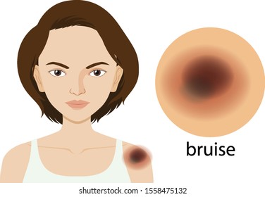 Woman with bruise on skin illustration