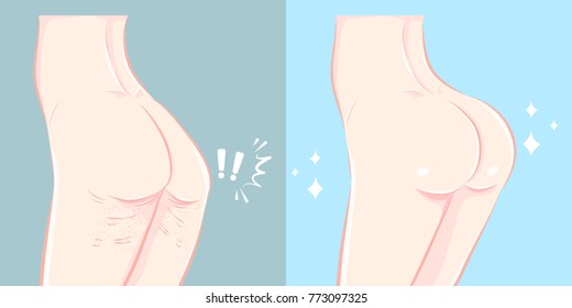 woman buttocks before and after cellulite on the blue background