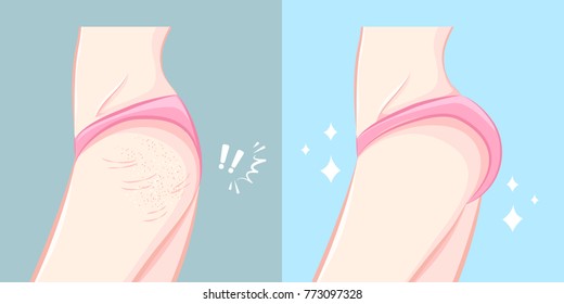 woman buttocks before and after cellulite on the blue background