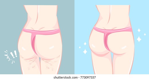 woman buttocks before and after cellulite on the blue background