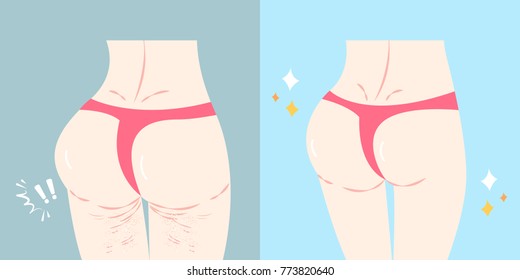 woman buttocks before and after cellulite on the blue background