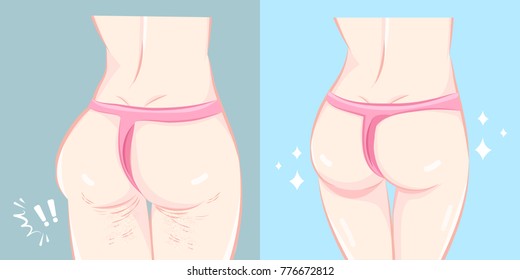 woman buttocks before and after cellulite on the blue background