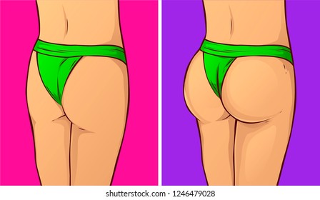 Woman Buttocks, Before-after. Vector Illustration. 