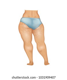 Woman buttocks and legs with cellulite