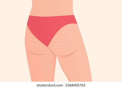 nalgas de mujer con marcas de estiramiento- ilustración vectorial
