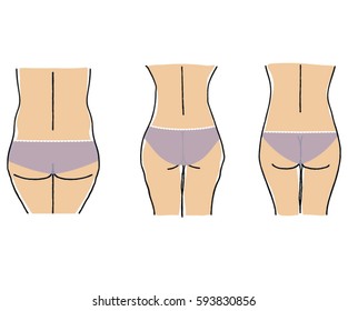 Woman cellulite skin at the bottom. Slim, fat and wobbly female buttocks. Vector illustration.