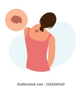 Woman With  Dark Brown Pigment Spot On Skin. Melanoma, Dermatology, Mole Screening, Birthmark. Dermatology, Cosmetology Concept.World Melanoma Day. Vector Illustration